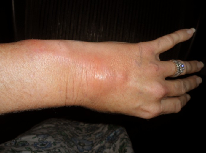 phlebitis pictures 3