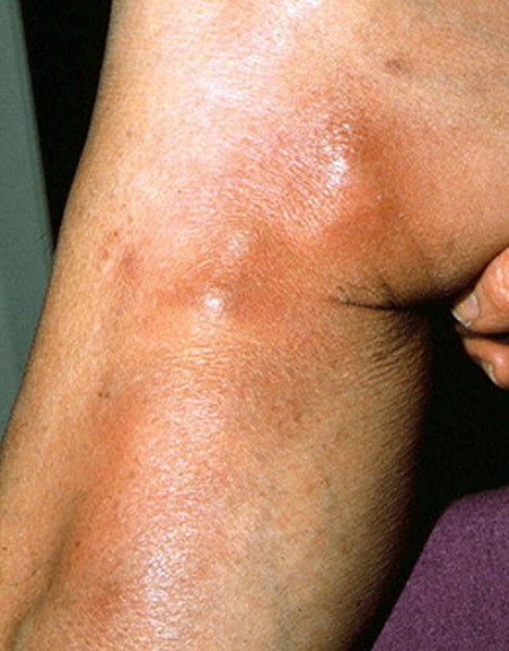 phlebitis pictures 4