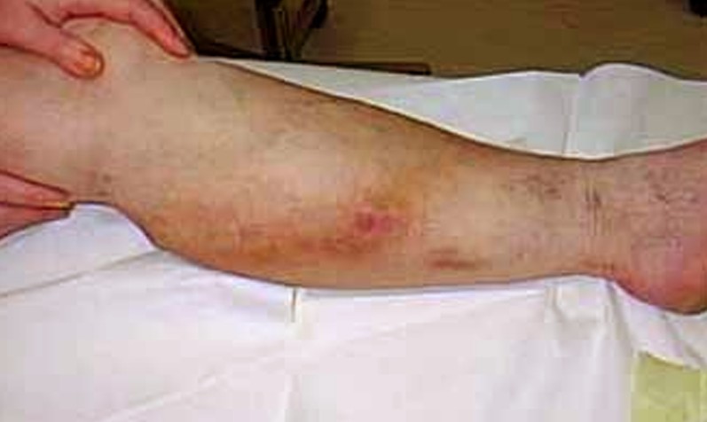 phlebitis pictures 5
