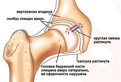 Коксартроз тазобедренного сустава. Симптомы и лечение. Хондропротекторы, ЛФК, диета, массаж