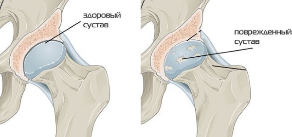 Коксартроз тазобедренного сустава. Симптомы и лечение. Хондропротекторы, ЛФК, диета, массаж