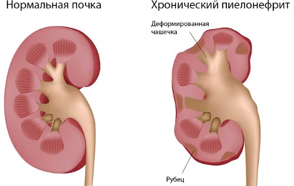 Боль в левом боку на уровне талии со спины, спереди, сбоку у женщин. Причины, лечение