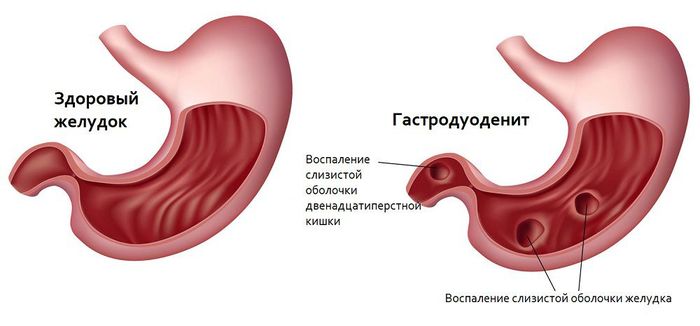 Боль под правой лопаткой сзади со спины. Причины и лечение