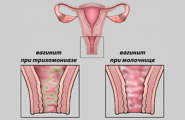 Болезненное мочеиспускание у женщин частое, в конце, с кровью. Причины и лечение