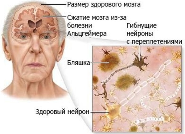 Старческое слабоумие. Симптомы и признаки у женщин, лечение деменции, препараты, уход