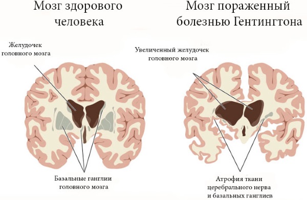 Старческое слабоумие. Симптомы и признаки у женщин, лечение деменции, препараты, уход