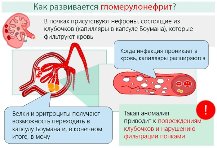 Грыжа под глазами. Причины и лечение у женщин. Фото, как избавиться без операции народными средствами, убрать операцией