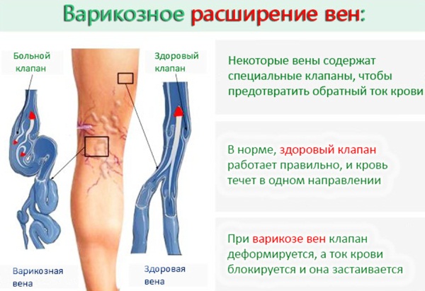 Мышечный спазм в ногах. Причины, симптомы и лечение