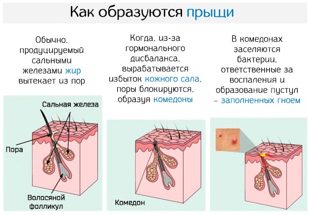 Сыпь на грудине у женщин. Причины, фото, чем лечить