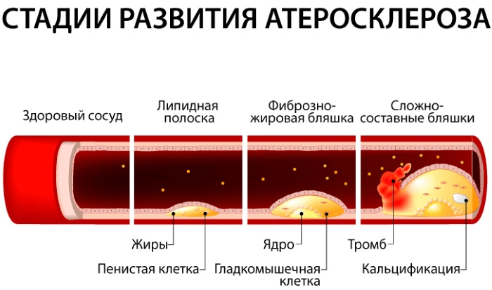 Мышечный спазм в ногах. Причины, симптомы и лечение