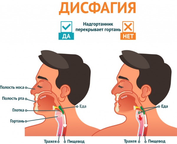 Эзофагит. Симптомы и лечение лекарствами, народными средствами, диета