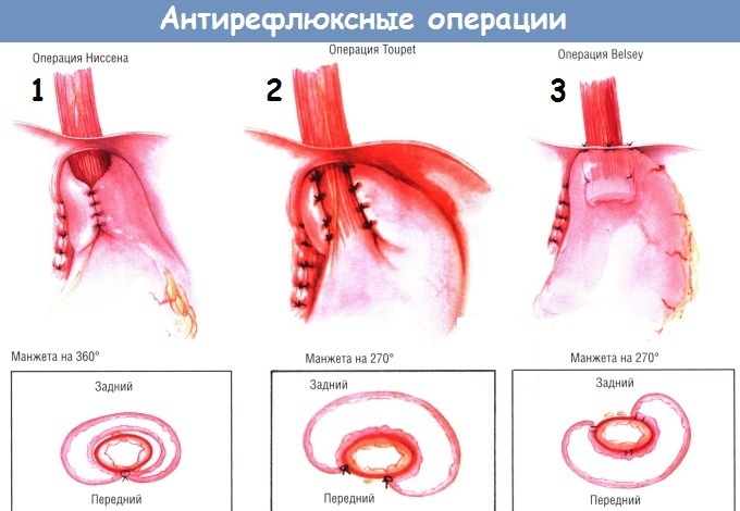 Эзофагит. Симптомы и лечение лекарствами, народными средствами, диета