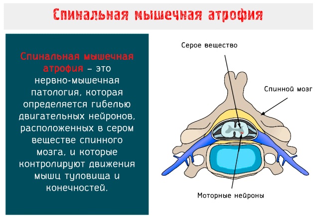 Спинально-мышечная атрофия у детей, взрослых. Что это такое, симптомы, лечение, клинические рекомендации