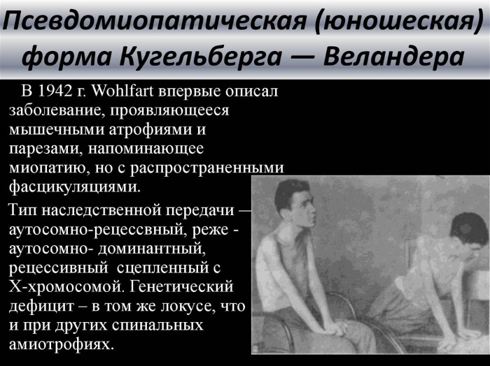 Спинально-мышечная атрофия у детей, взрослых. Что это такое, симптомы, лечение, клинические рекомендации