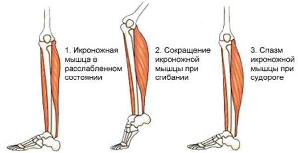 Мышечный спазм в ногах. Причины, симптомы и лечение