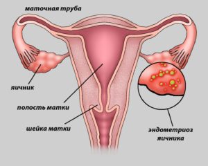 причины у женщин - яичник