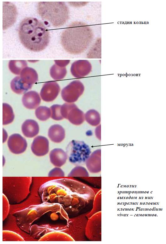Малярия клетки. Эритроцитарная шизогония малярийного плазмодия. Малярийный плазмодий Vivax. Шизонт малярийного плазмодия строение. Малярийный плазмодий в эритроцитах крови.