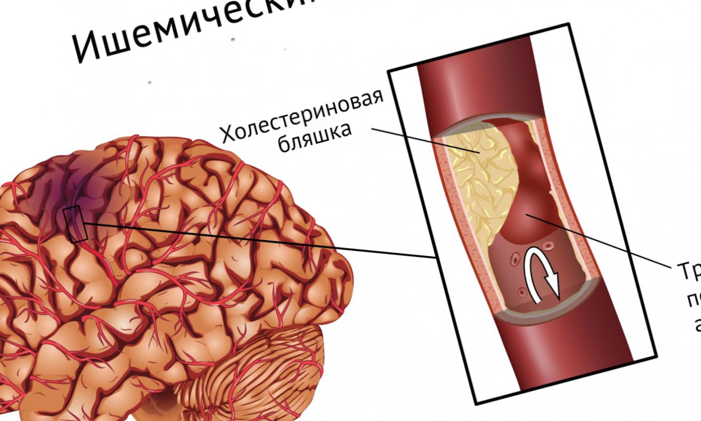 Что такое ишемический инсульт головного мозга. Ишемический эмболический инсульт. Ишемический инсульт поражения артерий. Ишемический инсульт рисунок. Картинки на тему инсульт.