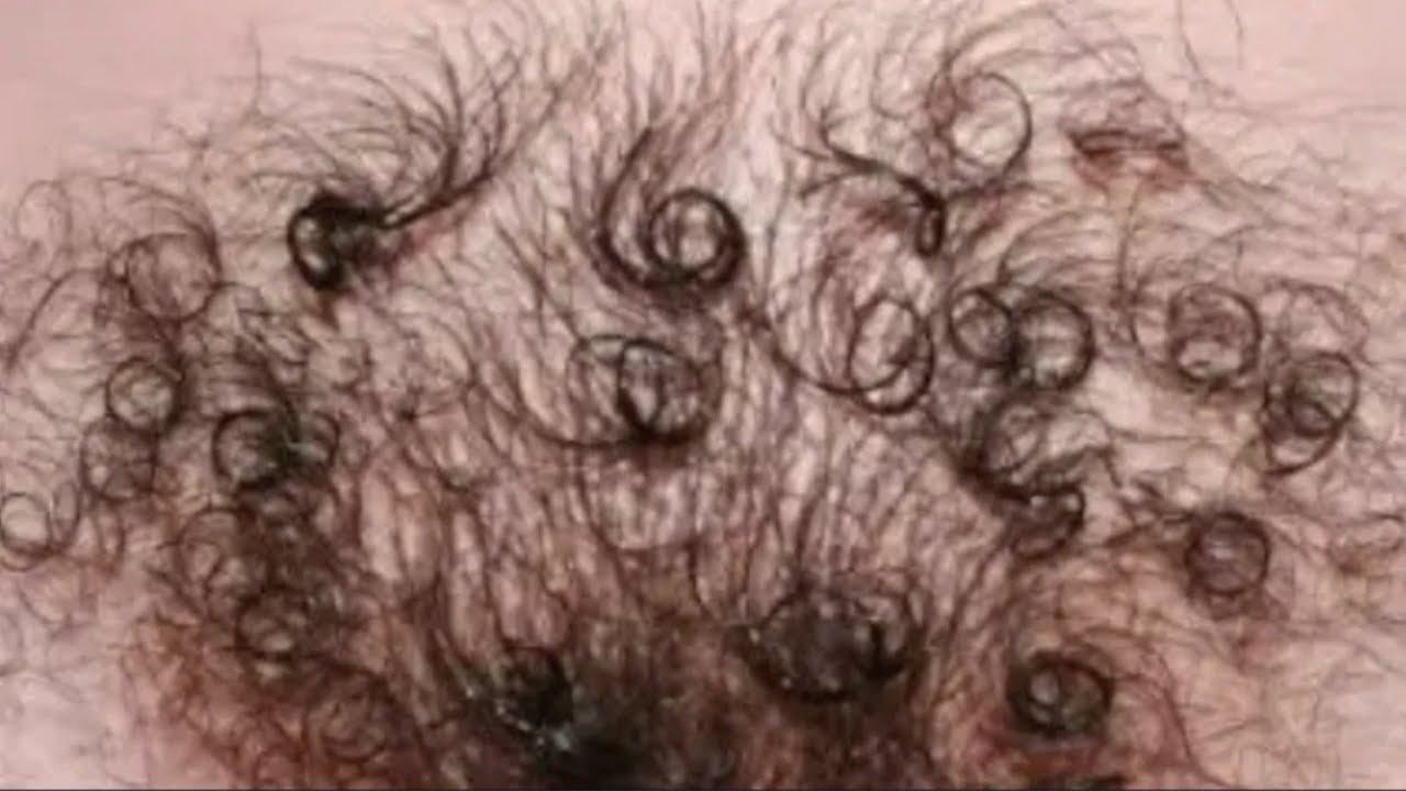 Черные волосы волосатые. Контагиозный моллюск в промежности. Контагиозный моллюск на бикини.