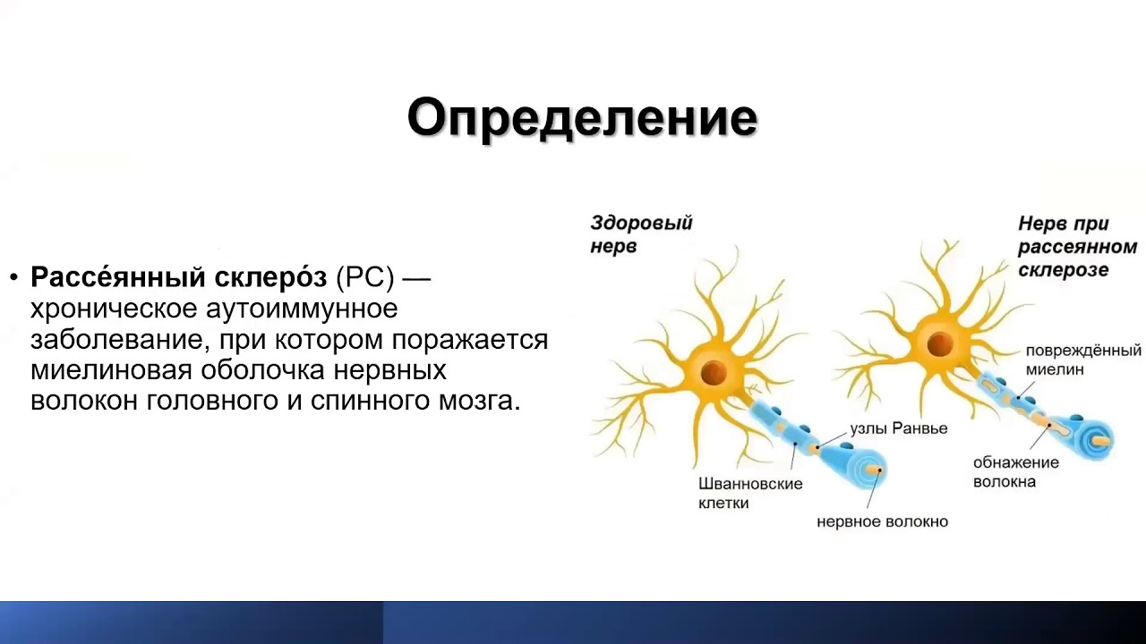 Заболевание рассеянный. Рассеянный склероз. Церебральная форма рассеянного склероза. Стволовая форма рассеянного склероза. Рассеянный склероз картинки.