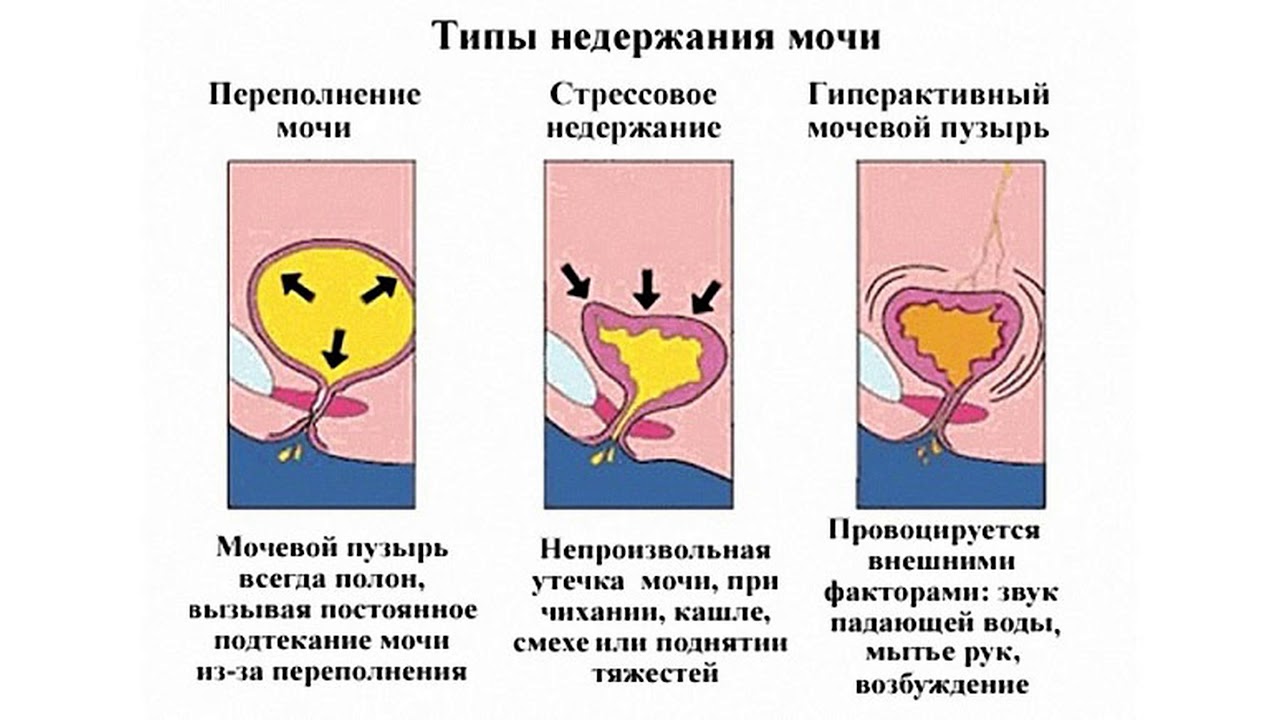 Недержание мочи презентация