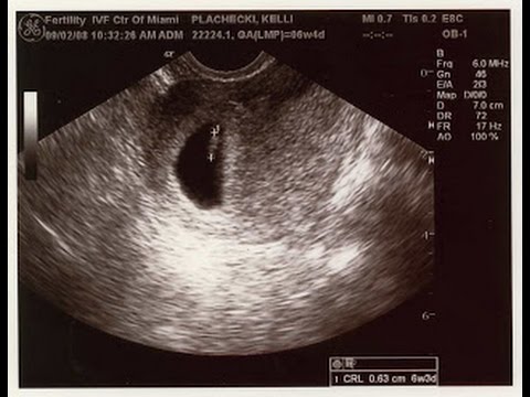 Фото узи на 9 недель беременности плода