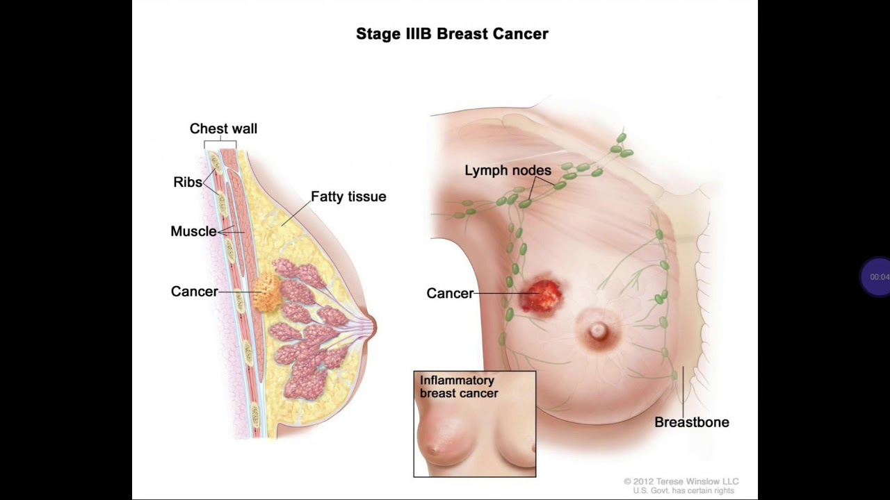 злокачественная опухоль в груди у женщин фото 84