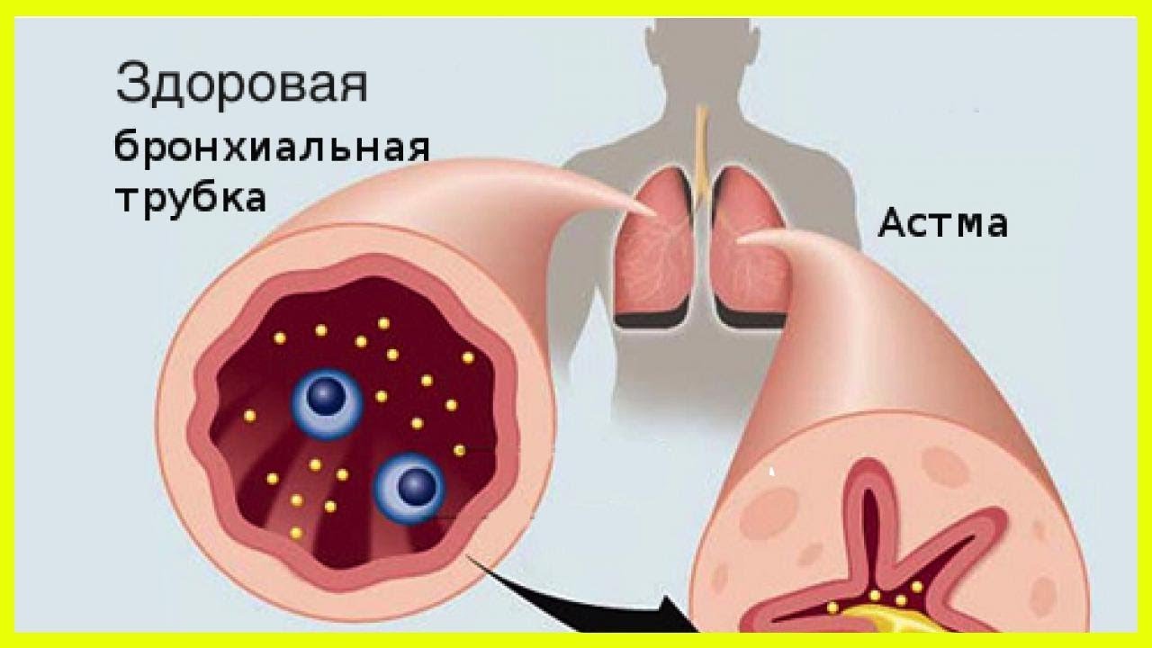 Индуцированная астма. Бронхиальная астма. Астма легкие. Бронхиальная астма картинки. Бронхиальная астма легкие.