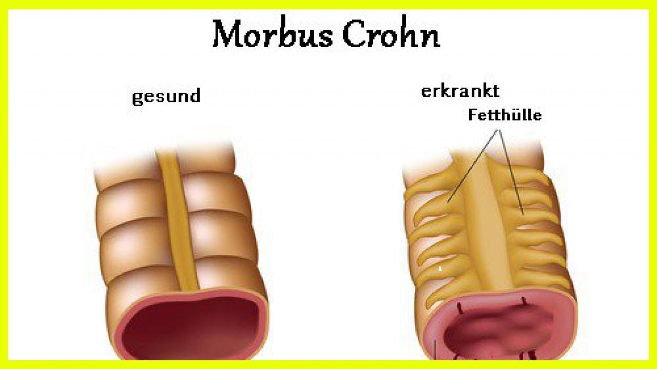 Chocolate y enfermedad de crohn