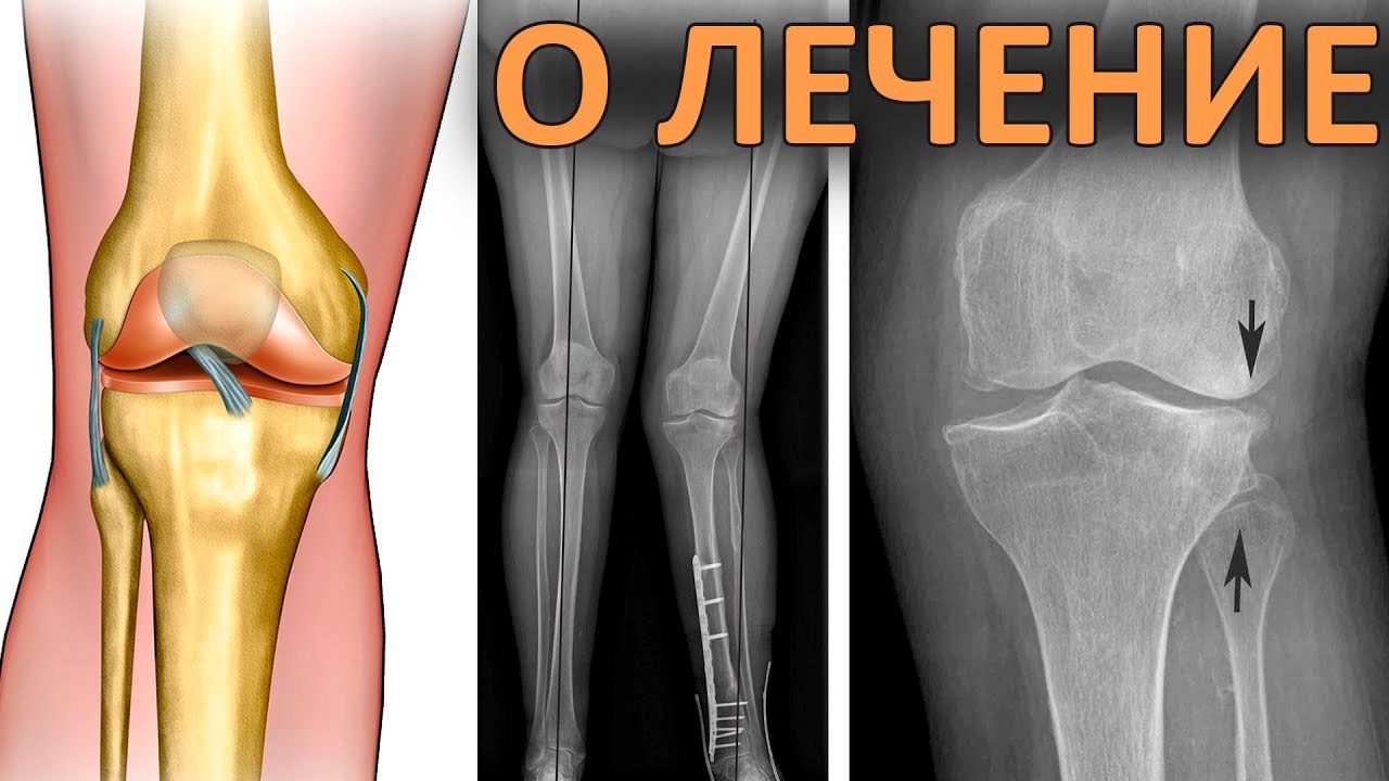 Сустав 1а. Деформирующий гонартроз. Деформирующий остеоартроз коленного сустава (гонартроз). Симптомы гонартроза коленного сустава.