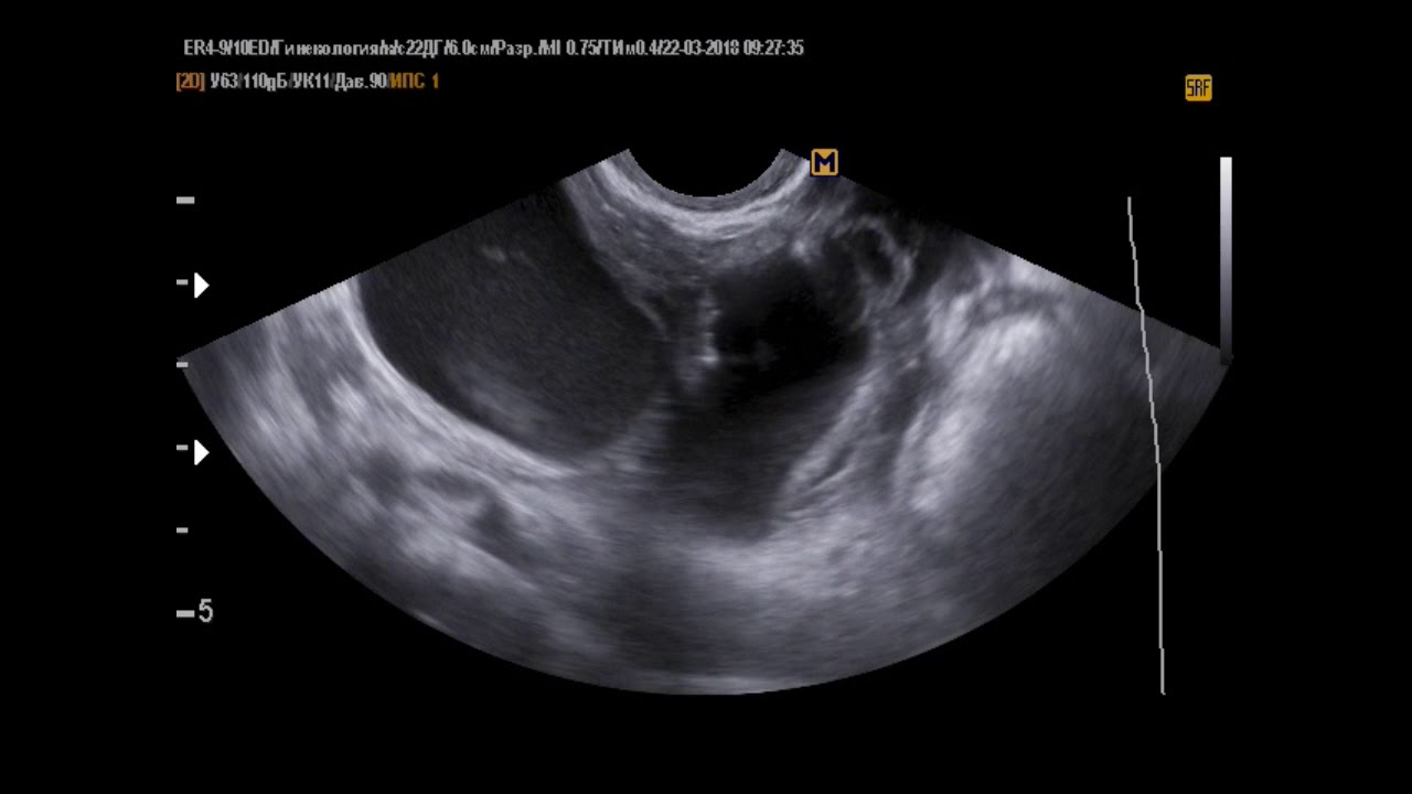 Параовариальная киста на узи фото