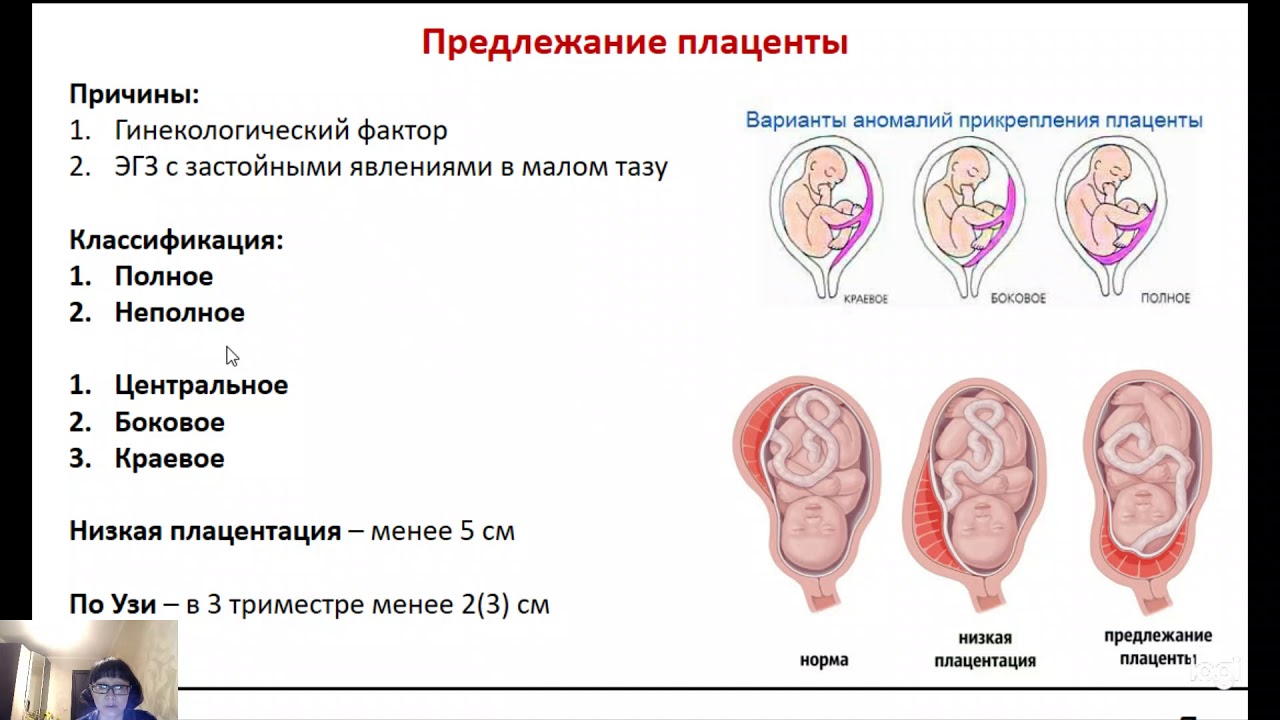 Полное предлежание при беременности. Клиническая классификация предлежания плаценты. Предлежание плаценты классификация диагностика. Типы прикрепления плаценты. Предлежание плаценты при беременности.