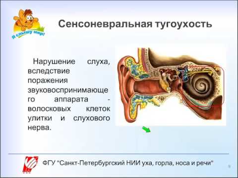 Сенсоневральная тугоухость картинки