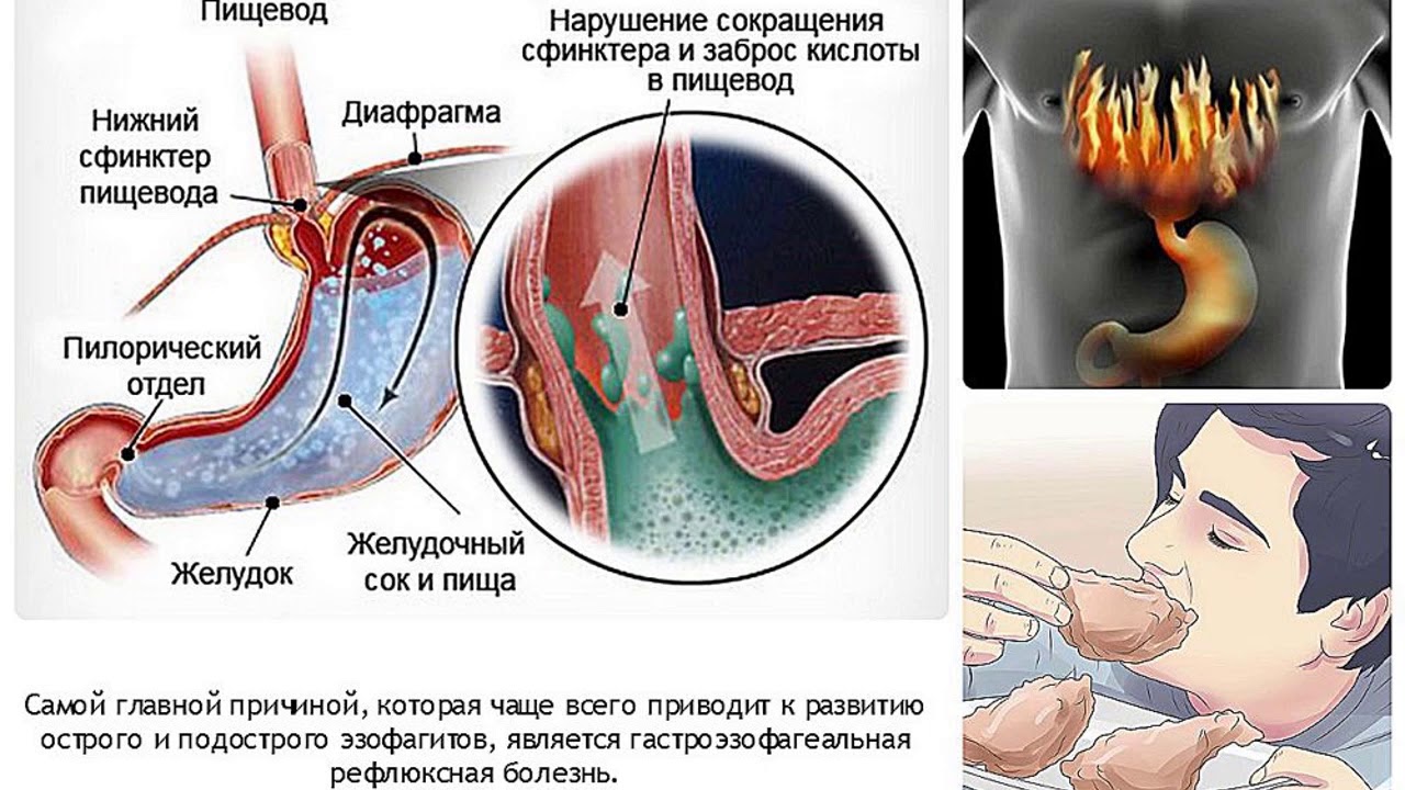 Гастроэзофагеальный рефлюкс (гэр)