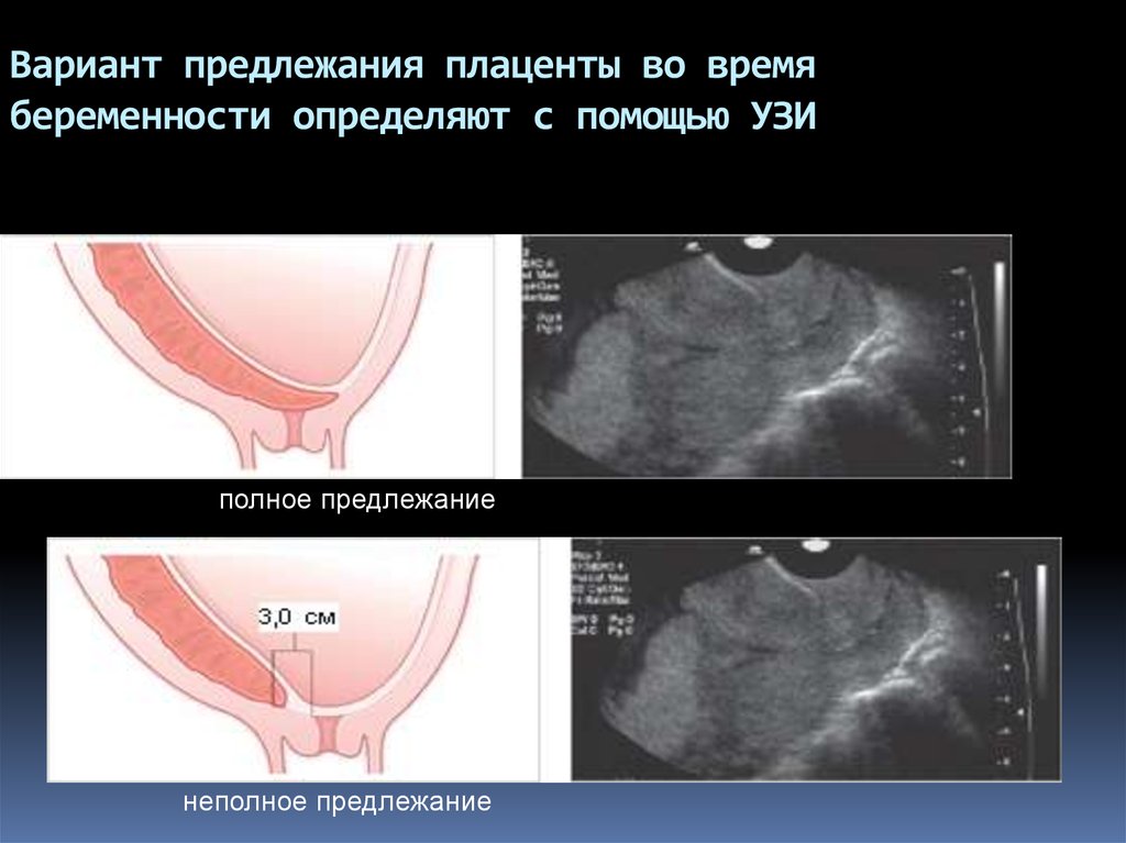 Предлежание плаценты картинки