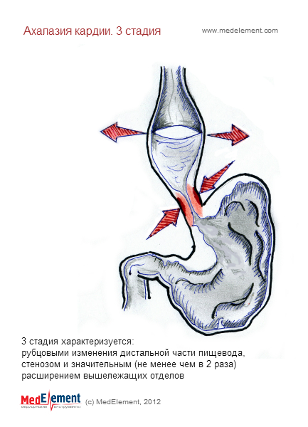 Недостаточность кардиального жома что это такое