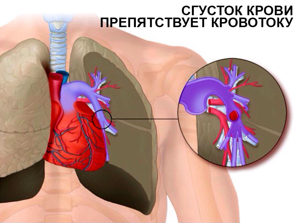 Сердечный тромбоз. Тромбоэмболия легочной артерии симптомы. Тромбоэмболия легочной артерии (Тэла). Симптомы эмболии легочных сосудов.