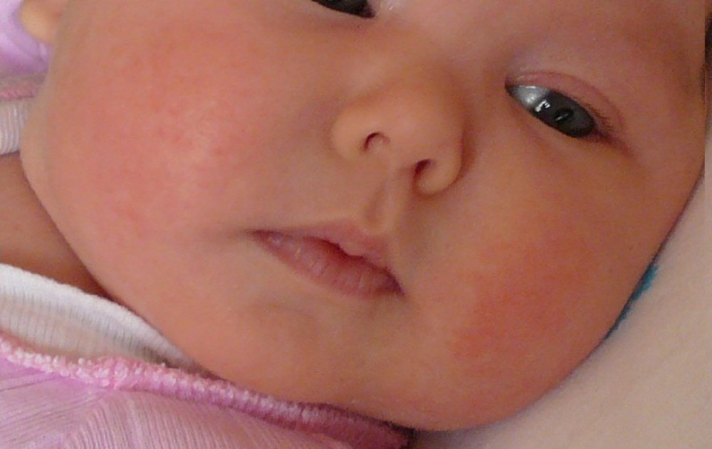 Гормональные прыщи на лице у новорожденного фото