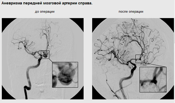 Аневризма средней мозговой артерии. Аневризма в переднемозговой артерии. Аневризма мешотчатая операция. Мешотчатая аневризма мозговой артерии.