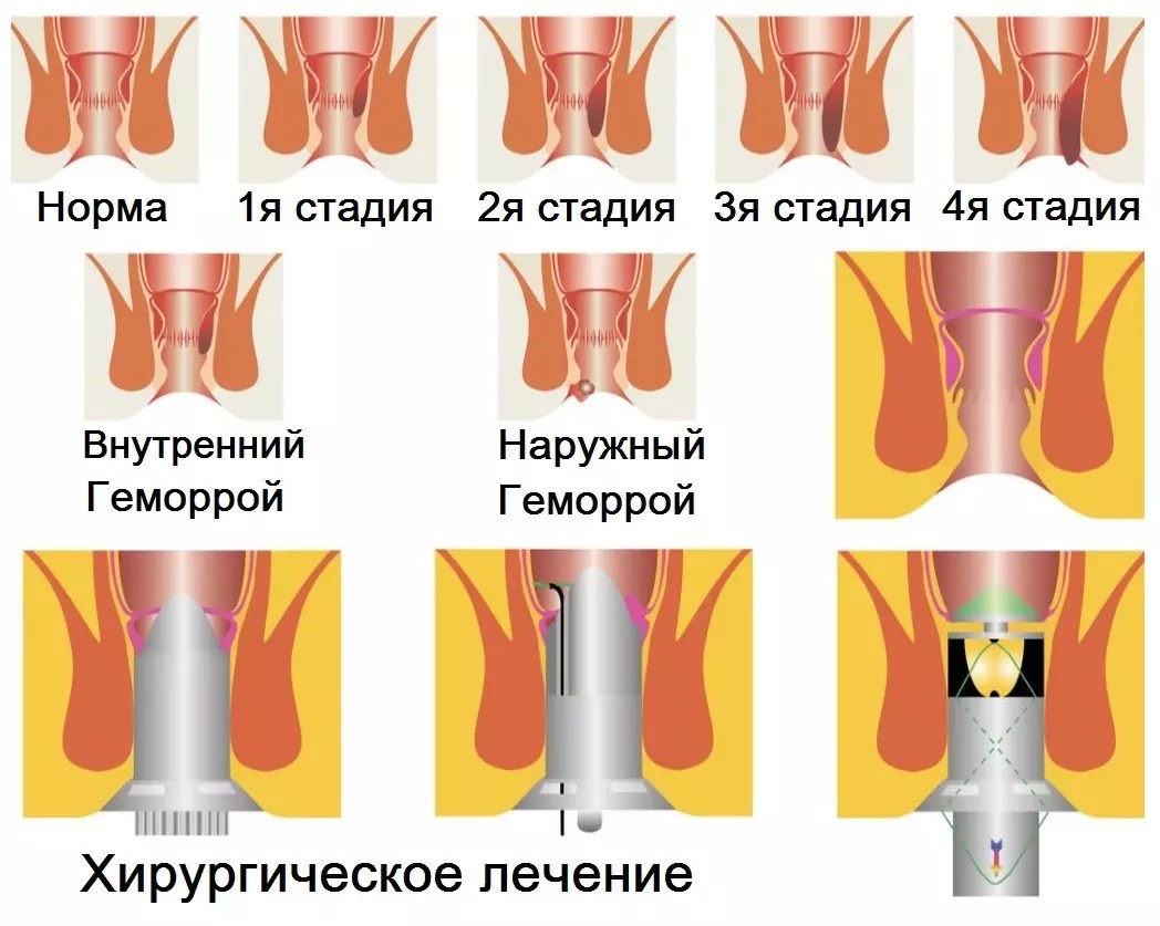 Стадии наружного геморроя схема