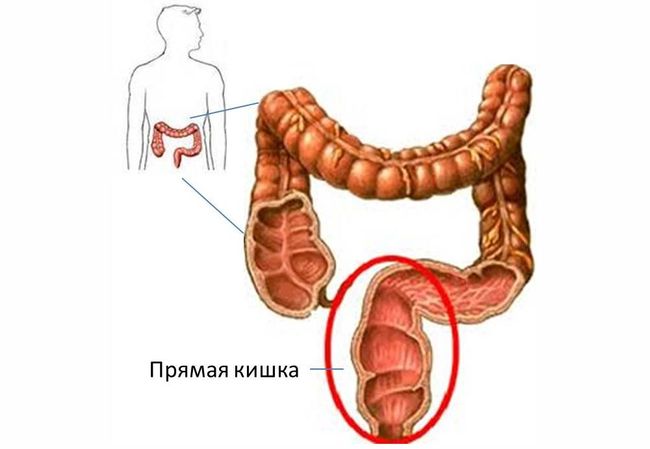 Признак рака прямой. Киста стенки прямой кишки. Ранение Толстого кишечника.