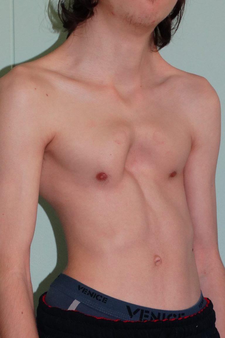 воронкообразная грудь у мужчин фото 95