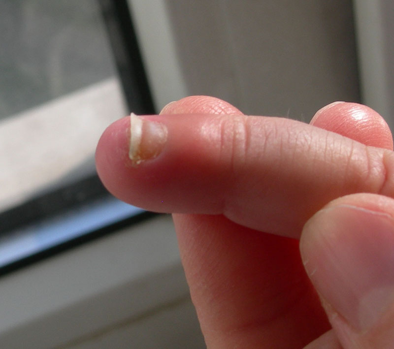 Нарыва на пальце лечение Нарыв на пальце возле ногтя