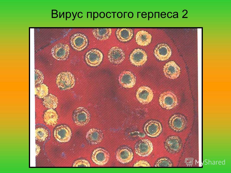 Вирус герпеса 2. Герпес микробиология культивирование. Микробиологическая диагноз вируса герпеса. Вирус простого герпеса 1 типа под микроскопом.