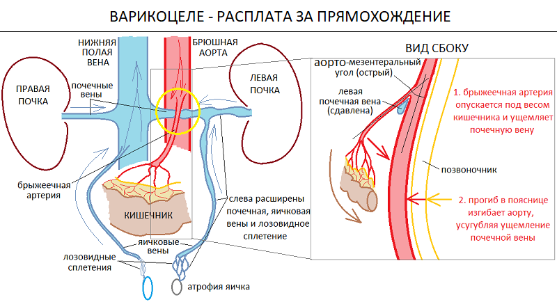 Боль внизу яичка у мужчин. Варикоцеле почечная Вена. Аорто-мезентериальной компрессии левой почечной вены..