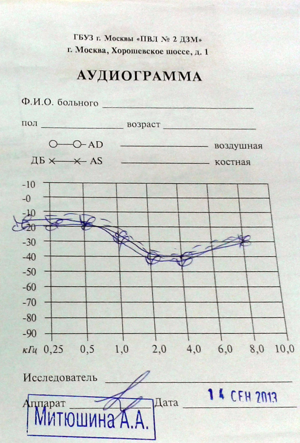 Нормальная аудиограмма фото