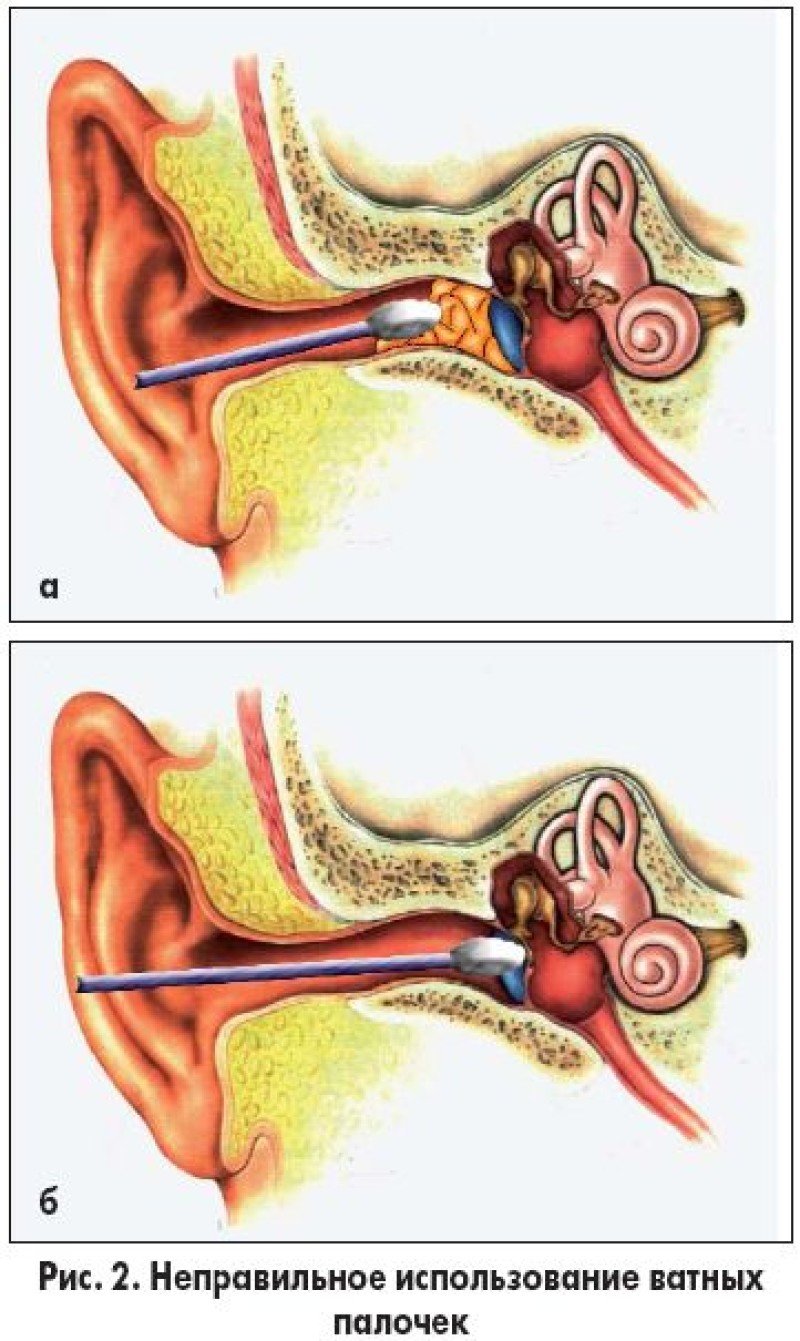 Как вытащить воду из уха