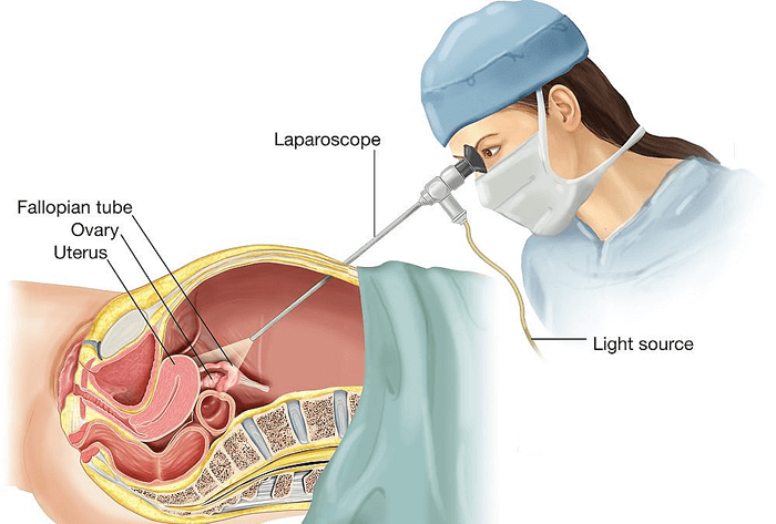 LPS-endometriosis