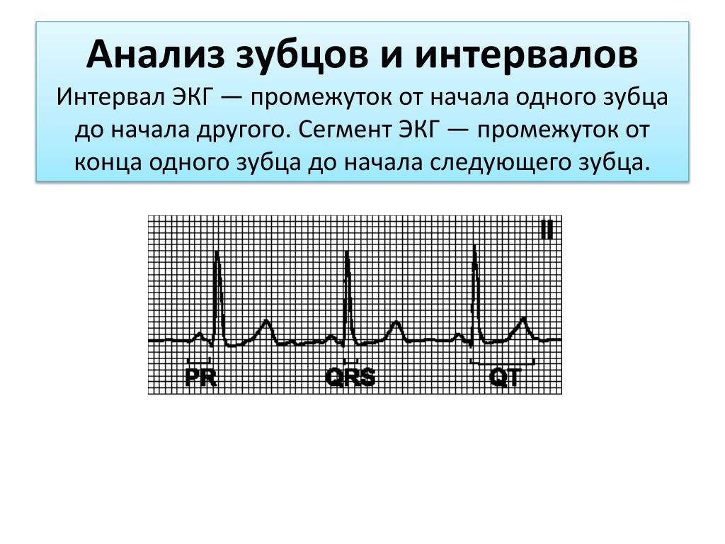 Сегменты экг