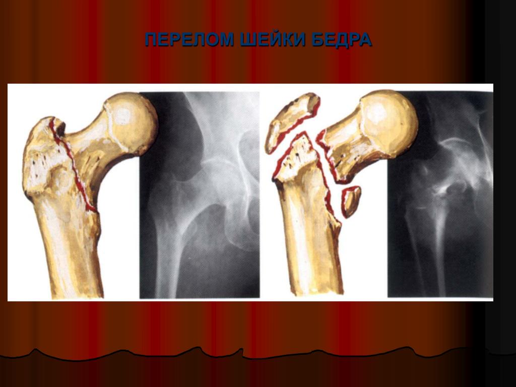 Повреждение бедренной кости. Внесуставные переломы шейки бедра. Субтотальный перелом шейки бедра. Чрезшеечный перелом шейки бедра. Субокципитальный перелом шейки бедра.